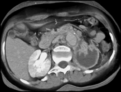 Left Renal Infarction S/P Aortic Aneurysm Repair With Occlusion of Left Renal Aa - CTisus CT Scan