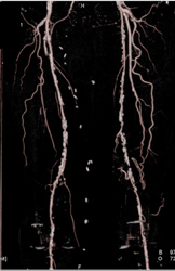 Peripheral Vascular Disease Superficial Femoral Artery (SFA) and Trifurcation Vessels - CTisus CT Scan