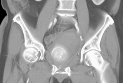 Internal Pudendal Aa Pseudoaneurysm - CTisus CT Scan