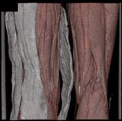 Normal Superficial Femoral Artery (SFA) and Popliteal AA S/P Trauma - CTisus CT Scan