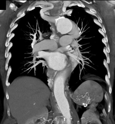 Abberant Right Subclavian Aa - CTisus CT Scan