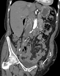 Occluded Abdominal Aorta Eith Extensive Collaterals of Bilateral Axillary-from Bypass Grafts - CTisus CT Scan