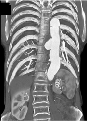 Ulceration of Descending Aorta - CTisus CT Scan