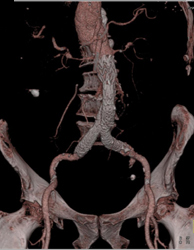 Patent Endovascular Stent - CTisus CT Scan