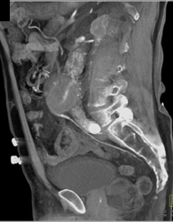 Endoleak - CTisus CT Scan