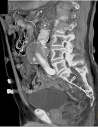 Endoleak - CTisus CT Scan