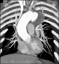 Aortic Arch Pseudoaneurysm - CTisus CT Scan