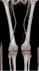 Diseased Popliteal Aa - CTisus CT Scan