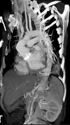 Normal Post-op Arch - CTisus CT Scan