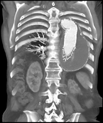 Stent in Descending Aortic Aneurysm - CTisus CT Scan