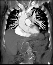 Stent for Repair of Thoracic Dissection - CTisus CT Scan