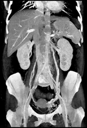 Prominent Gonadal Veins and Pelvic Vascular ??? - CTisus CT Scan