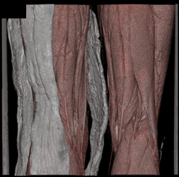 Patent Popliteal Aa S/P Trauma - CTisus CT Scan