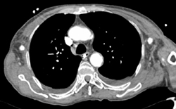 Bilateral Axillary-fem Grafts Due to Occluded Abdominal Aorta - CTisus CT Scan