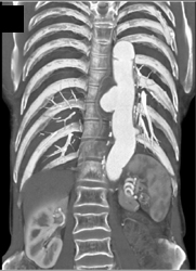 Focal Aneurysm of Descending Thoracic Aorta - CTisus CT Scan