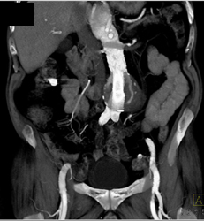 Endoleak - CTisus CT Scan