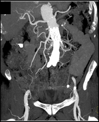 Endoleak - Vascular Case Studies - CTisus CT Scanning