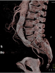 Endoleak - CTisus CT Scan