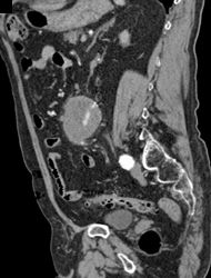 Endoleak - CTisus CT Scan