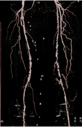 Diseased Bilateral SFAs - CTisus CT Scan