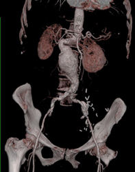 Abdominal Aortic Aneurysm (AAA) - CTisus CT Scan