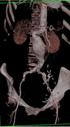 Abdominal Aortic Aneurysm (AAA) - CTisus CT Scan