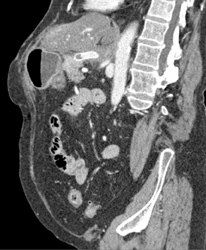 Occluded Celiac Aa Stent - CTisus CT Scan