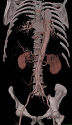 Type B Dissection - CTisus CT Scan