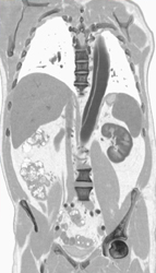 Type B Dissection - CTisus CT Scan