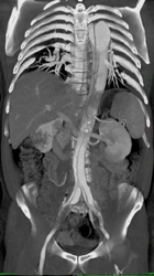 Type B Dissection - CTisus CT Scan