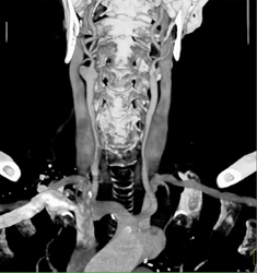 Carotid Stenosis - CTisus CT Scan