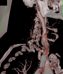 Carotid Stenosis - CTisus CT Scan