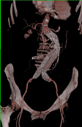 Endovascular Stent - CTisus CT Scan