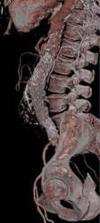 Endovascular Stent - CTisus CT Scan