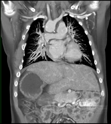 Situs Inversus With Congenital Heart Disease - CTisus CT Scan