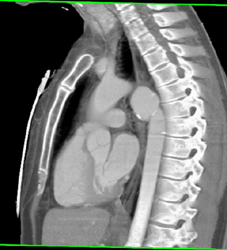 Old Traumatic Aneurysm - CTisus CT Scan