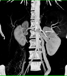 Dilated Gonadal Vein - CTisus CT Scan