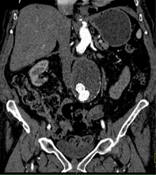 Endovascular Stent W/o Leak - CTisus CT Scan