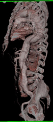 Aortic Dissection - CTisus CT Scan