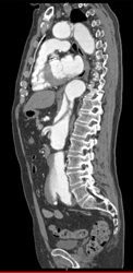 Aortic Dissection - CTisus CT Scan