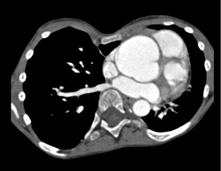 Dilated Aortic Root - CTisus CT Scan