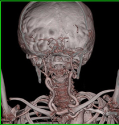 Loeys-Dietz Syndrome With Tortuous Carotid Arteries and Dilated Aortic Root - CTisus CT Scan