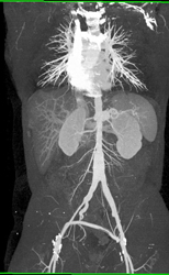 Fem-fem Bypass Grafts - CTisus CT Scan