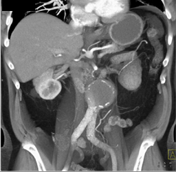 Abdominal Aortic Aneurysm (AAA) With Stents - CTisus CT Scan