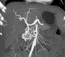 Median Arcuate Ligament - CTisus CT Scan