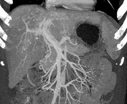 Portal Vein Thrombosis With Collaterals - CTisus CT Scan