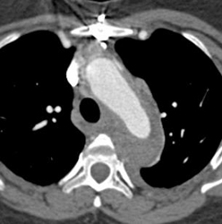 Aortic Dissection With Bleed - CTisus CT Scan