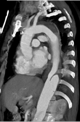 Aortic Dissection - CTisus CT Scan