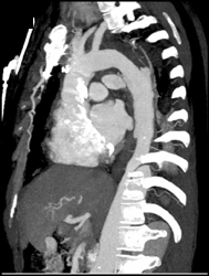 Aortic Dissection - CTisus CT Scan