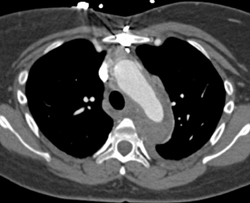 Aortic Dissection - CTisus CT Scan